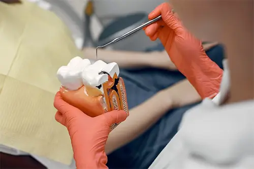 Tratamiento de conductos o endodoncia (sujeto a valoración)